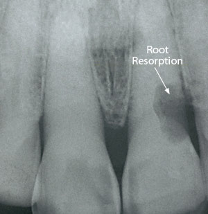 Dental root resorption